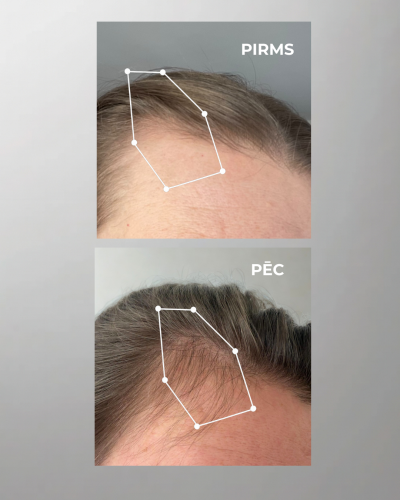 Komplekts matu augšanas veicināšanai - Image 2